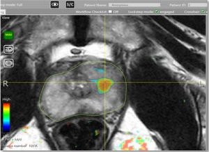 Untersuchung der Prostata im MRT mit Hilfe eines computerassistierten Detektionssystem