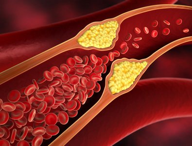 Durchblutungsstörung, Einengung einer Arterie
