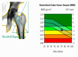 Auswertung einer DXA-Messung des linken Oberschenkelknochens