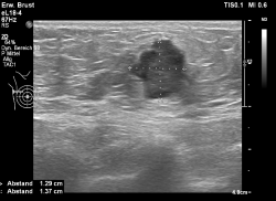 Aufnahme einer ultraschallgesteuerten Stanzbiopsie der Brust