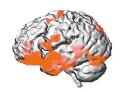 Abbildung eines Gehirns mit Frühwarnzeichen der Alzheimer-Erkrankung